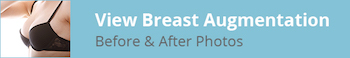 view breast augmentation photos